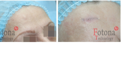 Фотона шлифовка рубцов 3